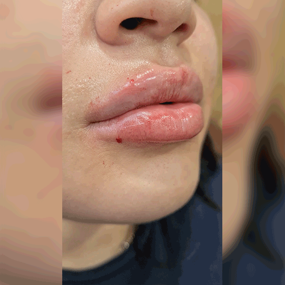 lip fillers